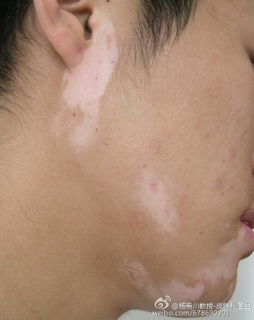 宁波治白癜风好的医院 面部白癜风有哪些治疗方案 宁波治白癜风好的医院 面部白癜风有哪些治疗方案