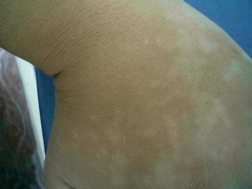 白癜风遗传到什么程度 白癜风遗传到什么程度