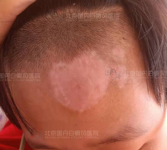 兰州哪个白癜风医院好白癜风对儿童的人际关系有影响吗 兰州哪个白癜风医院好白癜风对儿童的人际关系有影响吗