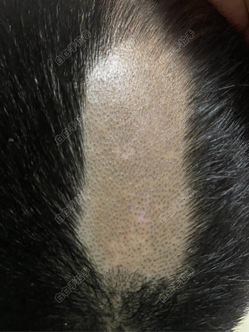 白癜风皮肤怎样恢复 白癜风的恢复过程 白癜风皮肤怎样恢复 白癜风的恢复过程