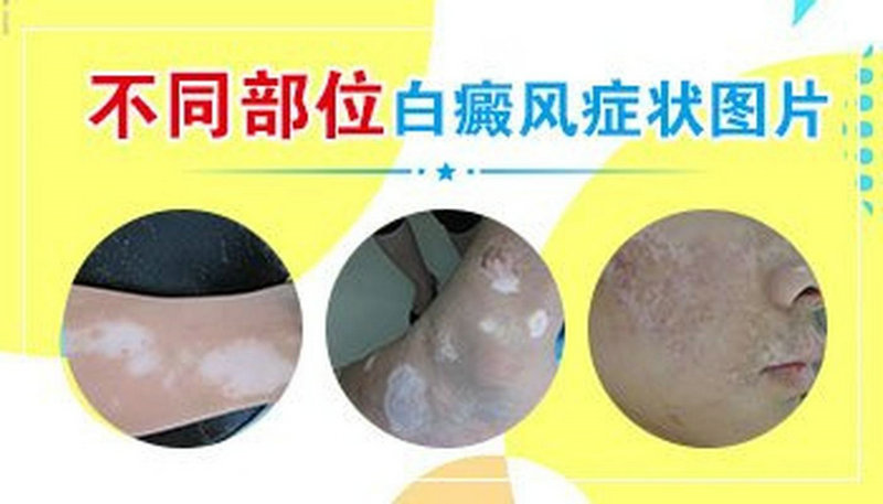 成都治疗白癜风的费用 成都治疗白癜风的费用