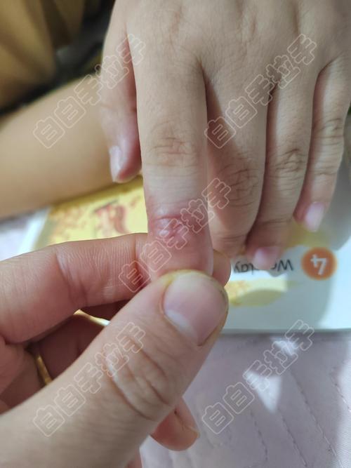 哪些措施可以预防白癜风的复发 哪些措施可以预防白癜风的复发