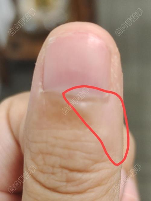 白癜风检查报告查询 白癜风检查结果怎么看 白癜风检查报告查询 白癜风检查结果怎么看