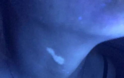 白癜风第十天怎么治疗 白癜风第十天怎么治疗