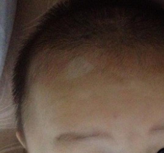 鸣人得了白癜风 鸣人白眼图片 鸣人得了白癜风 鸣人白眼图片