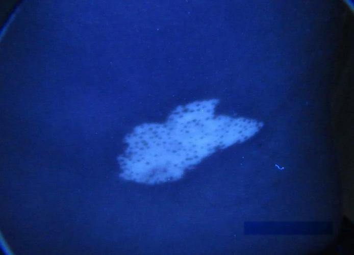 乌鲁木齐白癜风哪家好 乌鲁木齐白癜风哪家好