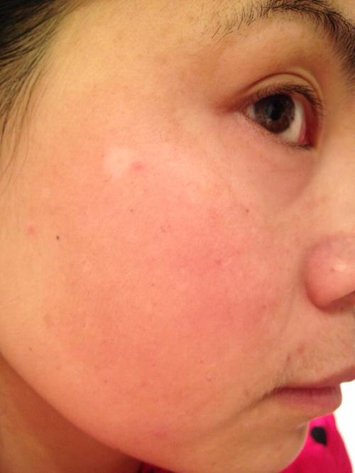 宁波白癜风医院哪些好 宁波白癜风医院哪些好