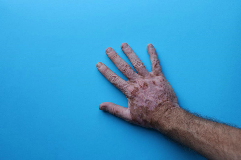 兰州治白癜风医院哪个正规 背部出现白斑是白癜风吗 兰州治白癜风医院哪个正规 背部出现白斑是白癜风吗