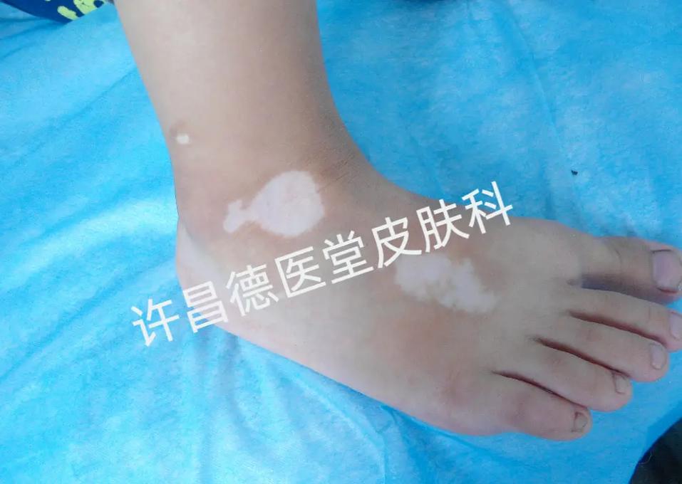 白癜风医院到底行不行 白癜风医院到底行不行