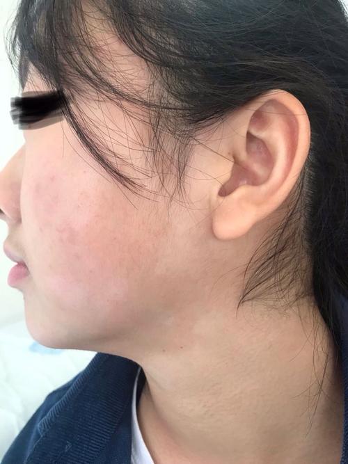 上海白癜风专家在线咨询 上海白癜风专家在线咨询