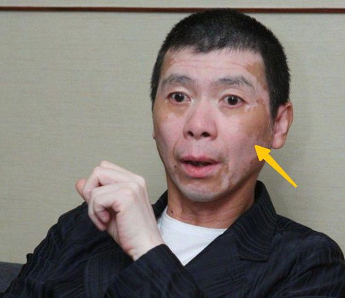 出现哪些症状说明白癜风有好转 徐州治白癜风的医院哪里好 出现哪些症状说明白癜风有好转 徐州治白癜风的医院哪里好