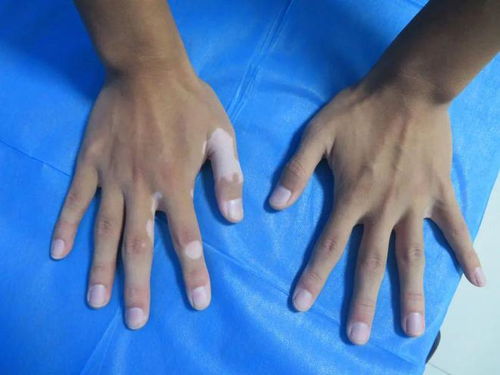 白癜风超模果蔬汁搭配 白癜风超模果蔬汁搭配