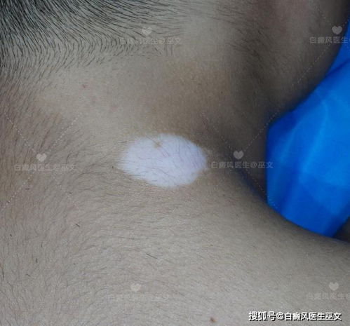 荆州治白癜风医院哪所好 白癜风 饮食 荆州治白癜风医院哪所好 白癜风 饮食