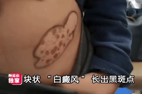 什么原因得白癜风的 常州治疗白癜风的医院 什么原因得白癜风的 常州治疗白癜风的医院