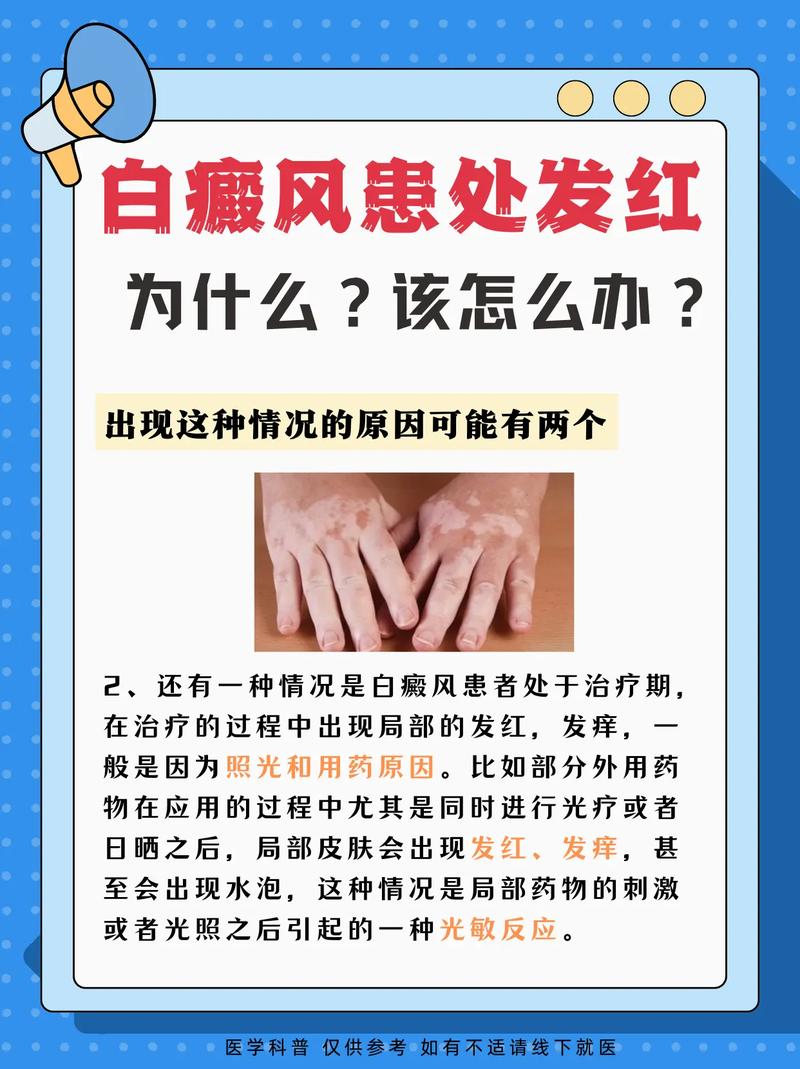 喝什么酵素治疗白癜风 喝什么酵素治疗白癜风