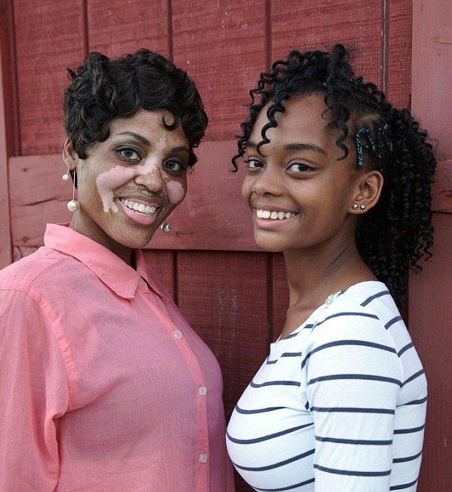 白癜风的药都有什么 白癜风有效果的药 白癜风的药都有什么 白癜风有效果的药