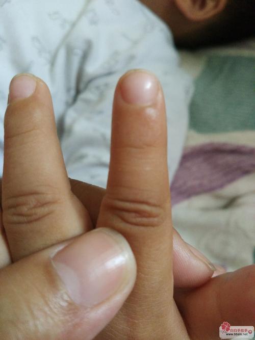 成都哪治疗白癜风 铜离子缺乏为什么会引发白癜风 成都哪治疗白癜风 铜离子缺乏为什么会引发白癜风