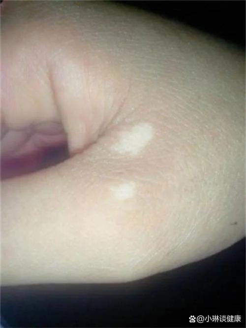 白癜风遗传几率是多少 松原治疗白癜风医院哪家有名 白癜风遗传几率是多少 松原治疗白癜风医院哪家有名