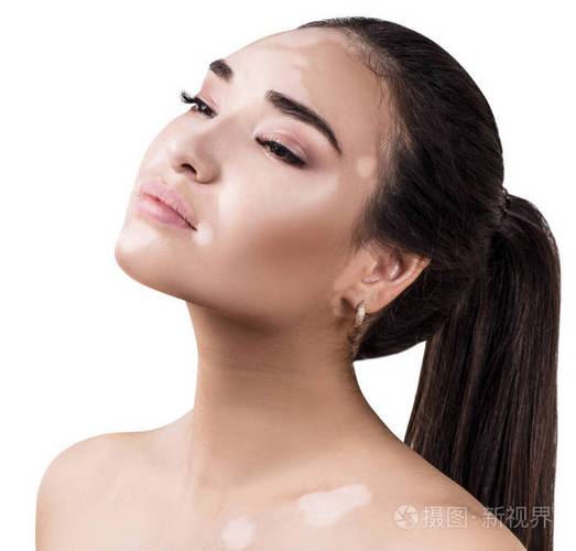 白癜风吃什么食物好 六安哪里能治疗白癜风 白癜风吃什么食物好 六安哪里能治疗白癜风