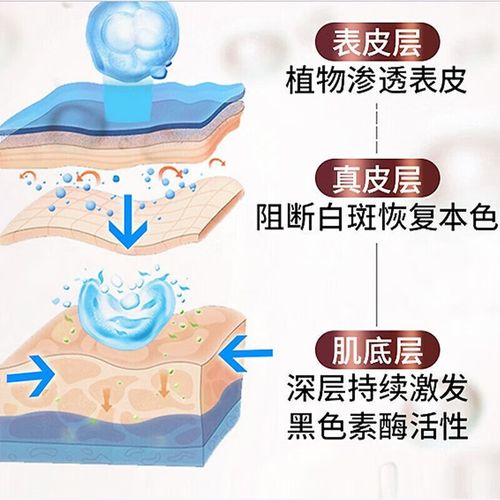 湛江专治白癜风医院是哪家 额头白癜风怎么治疗 湛江专治白癜风医院是哪家 额头白癜风怎么治疗