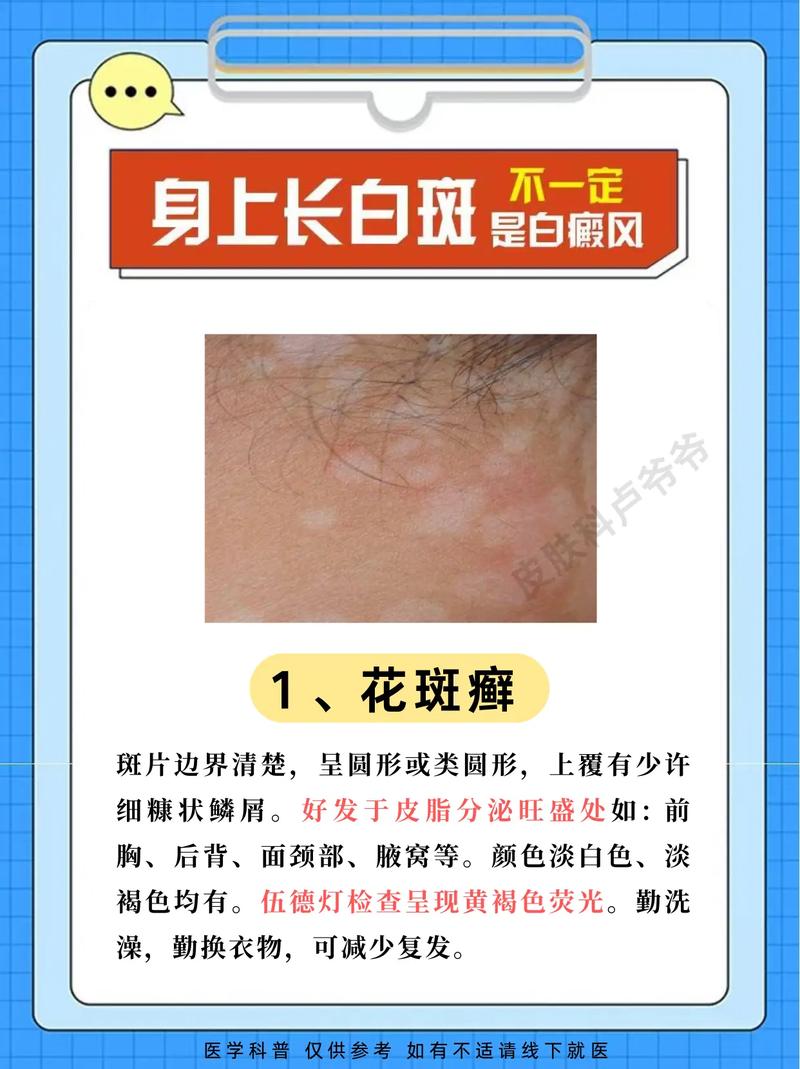 长沙治疗白癜风的好医院 泛发型白癜风有哪些危害 长沙治疗白癜风的好医院 泛发型白癜风有哪些危害