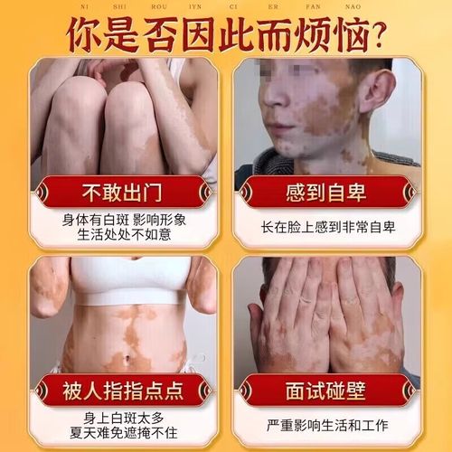 萍乡治白癜风好的专科医院 局限型白癜风的发病因素有哪些 萍乡治白癜风好的专科医院 局限型白癜风的发病因素有哪些