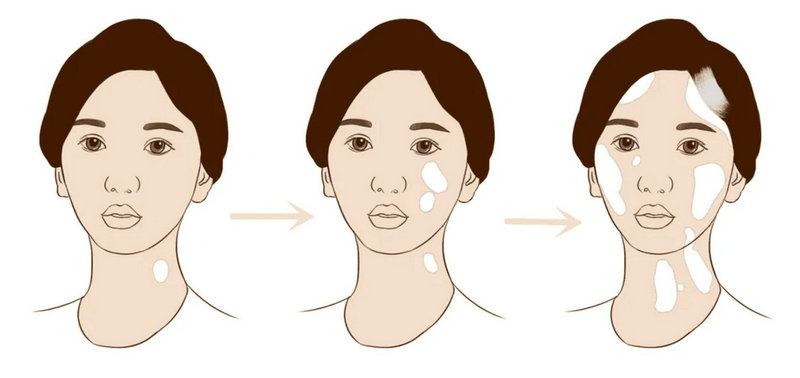 哪种软膏适合白癜风用 哪种软膏适合白癜风用