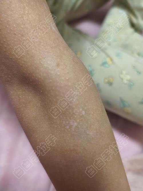 中山治疗白癜风的好医院 白癜风系统检查项目 中山治疗白癜风的好医院 白癜风系统检查项目