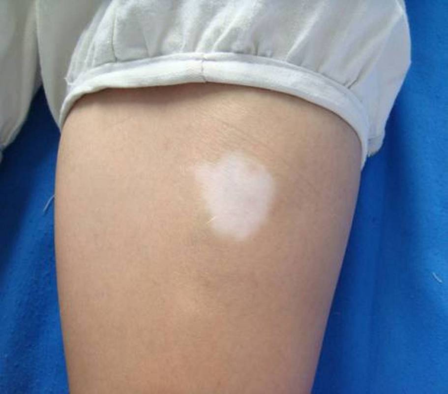 白癜风苏州九价 苏州白癜风到哪个医院 白癜风苏州九价 苏州白癜风到哪个医院