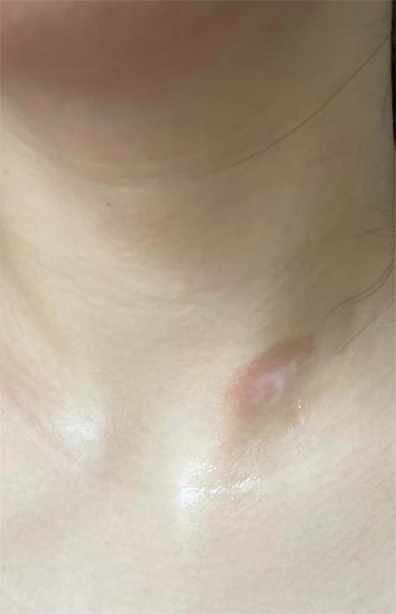 小孩白癜风的初期症状 上海治白癜风哪家医院知名 小孩白癜风的初期症状 上海治白癜风哪家医院知名