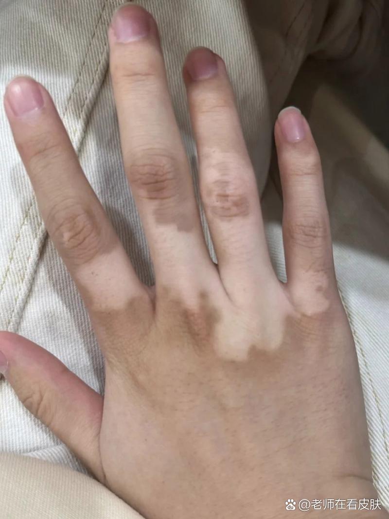 成都白癜风治疗哪家有名医院选择很关键 成都白癜风治疗哪家有名医院选择很关键