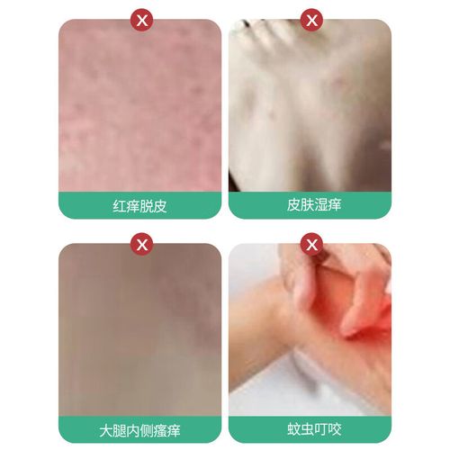 泉州治疗白癜风的好医院 小孩白癜风的初期症状 泉州治疗白癜风的好医院 小孩白癜风的初期症状