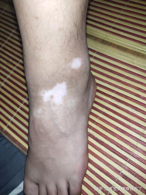 ����������ʲô���� �ں��������ư����ҽԺ��