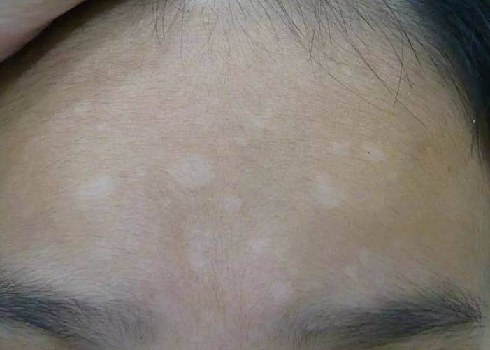 公开亮相 盐城白癜风医院排名品牌排名腊肉作为冬天的独特美味 白癜风患者能吃吗 公开亮相 盐城白癜风医院排名品牌排名腊肉作为冬天的独特美味 白癜风患者能吃吗