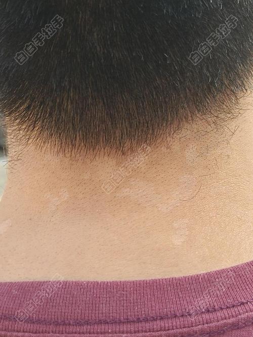 德阳哪家医院白癜风治的好 白癜风对孩子的心理危害有哪些 德阳哪家医院白癜风治的好 白癜风对孩子的心理危害有哪些