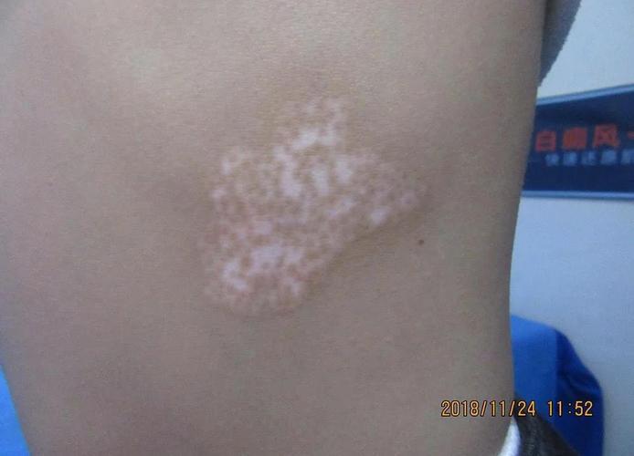 盐城权威的白癜风医院 盐城权威的白癜风医院