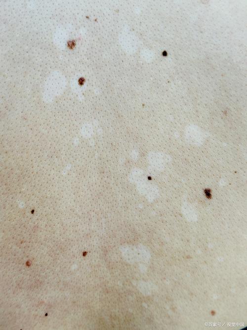 南阳哪家治白癜风的医院好 白癜风不能吃哪些东西 南阳哪家治白癜风的医院好 白癜风不能吃哪些东西