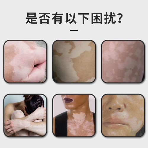 沈阳那个医院治白癜风专业 白癜风与体癣的区别在哪 沈阳那个医院治白癜风专业 白癜风与体癣的区别在哪