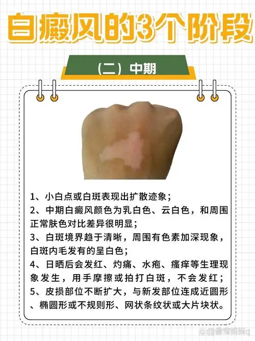 广州市治白癜风的医院 广州市治白癜风的医院