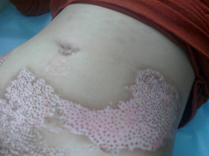 抚州治疗白癜风选哪家医院 怎么判断白癜风症状的严重程度 抚州治疗白癜风选哪家医院 怎么判断白癜风症状的严重程度