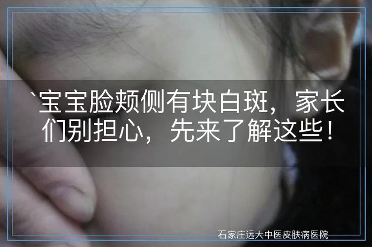 为什么白癜风要做血液检查 潍坊哪治疗白癜风更好 为什么白癜风要做血液检查 潍坊哪治疗白癜风更好