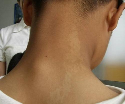 深圳哪里治白癜风权威 深圳哪里治白癜风权威