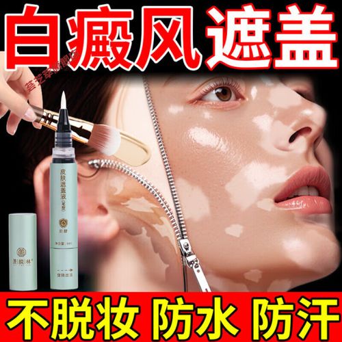 宁波治白癜风哪所医院好 感冒会对白癜风造成怎样的影响 宁波治白癜风哪所医院好 感冒会对白癜风造成怎样的影响