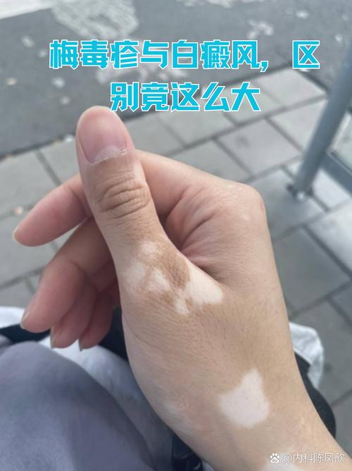 济南白癜风食谱简单 济南白癜风治疗地点 济南白癜风食谱简单 济南白癜风治疗地点