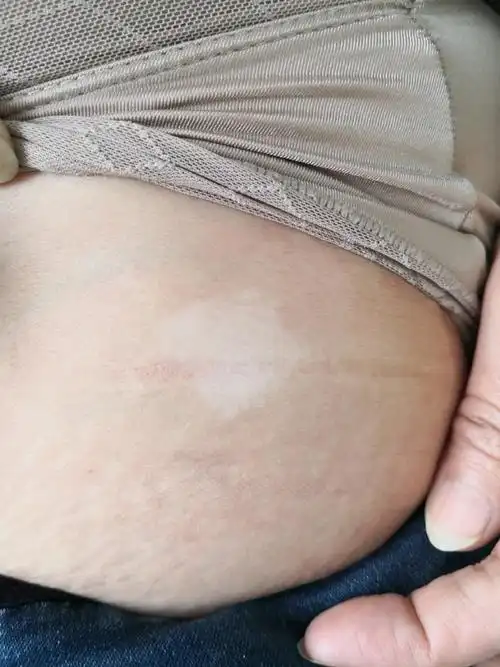 苏州看白癜风选哪个医院 苏州看白癜风选哪个医院