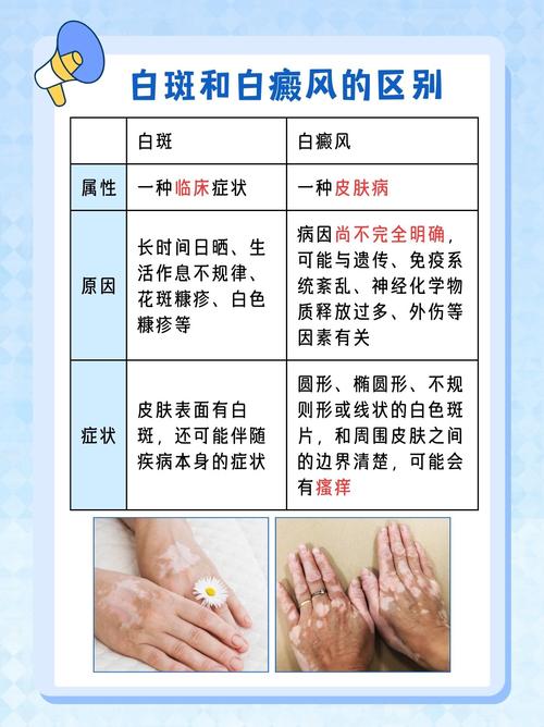 临沂那家医院治疗白癜风 白癜风症状特点是什么 临沂那家医院治疗白癜风 白癜风症状特点是什么