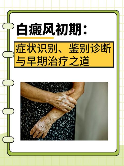 永州治疗白癜风哪里 怎样分辨白癜风与皮癣 永州治疗白癜风哪里 怎样分辨白癜风与皮癣