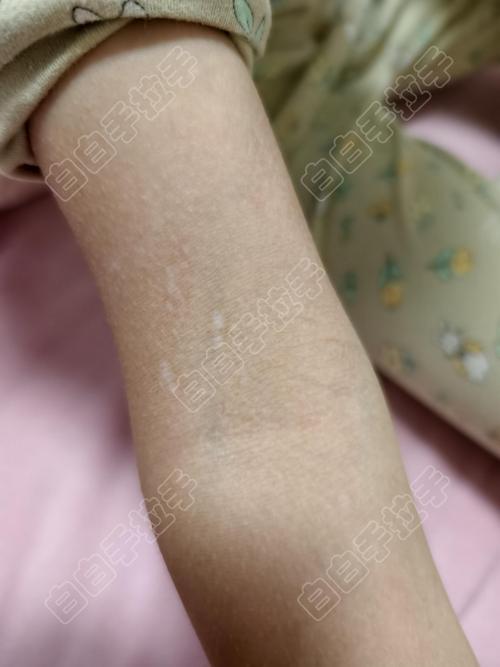 口唇白癜风的治疗难点 口唇白癜风的治疗难点