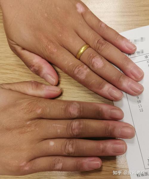 常接触哪些化学物质易患白癜风 大庆治疗白癜风的医院 常接触哪些化学物质易患白癜风 大庆治疗白癜风的医院