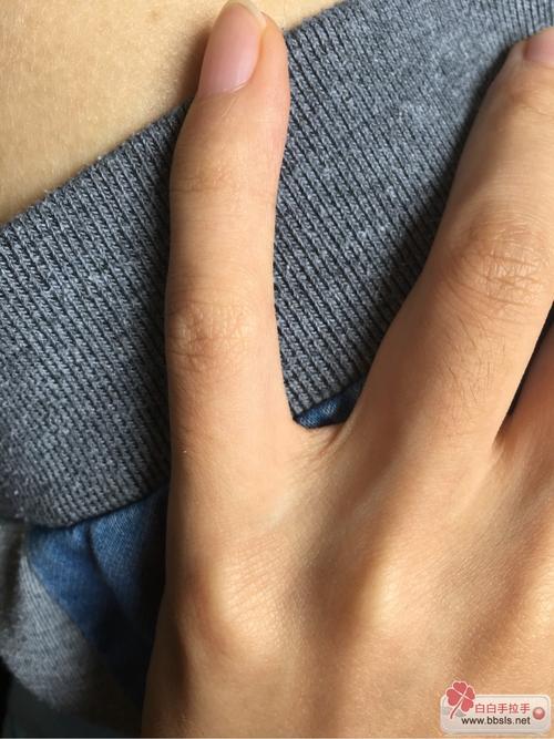 杭州治疗白癜风去哪家好 杭州治疗白癜风去哪家好